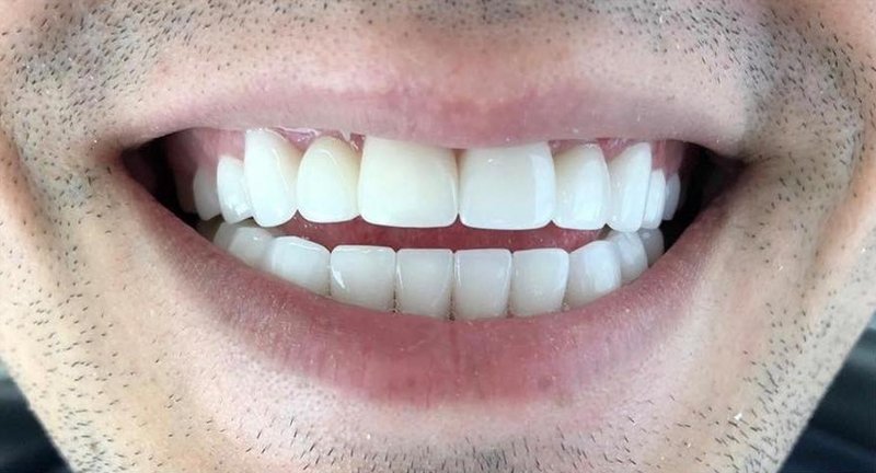 After Treatment 1