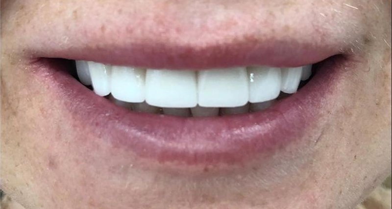After Treatment 3