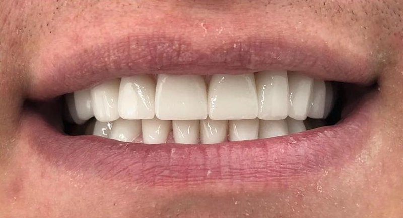 After Treatment 4