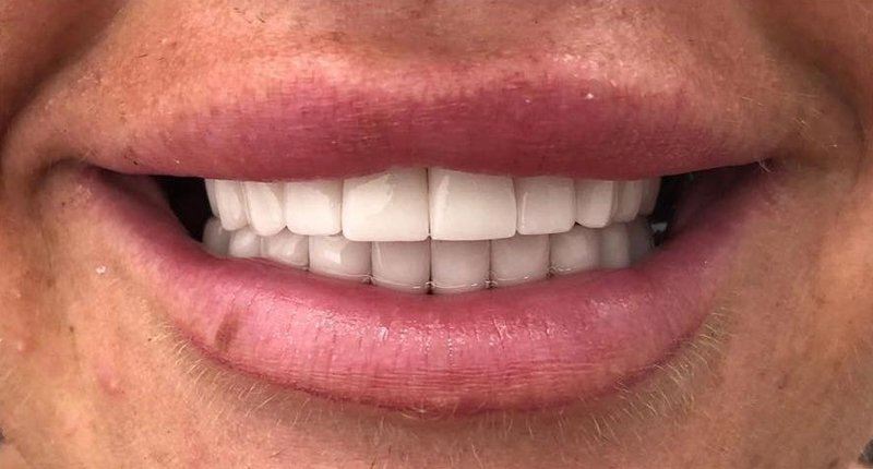 After Treatment 5