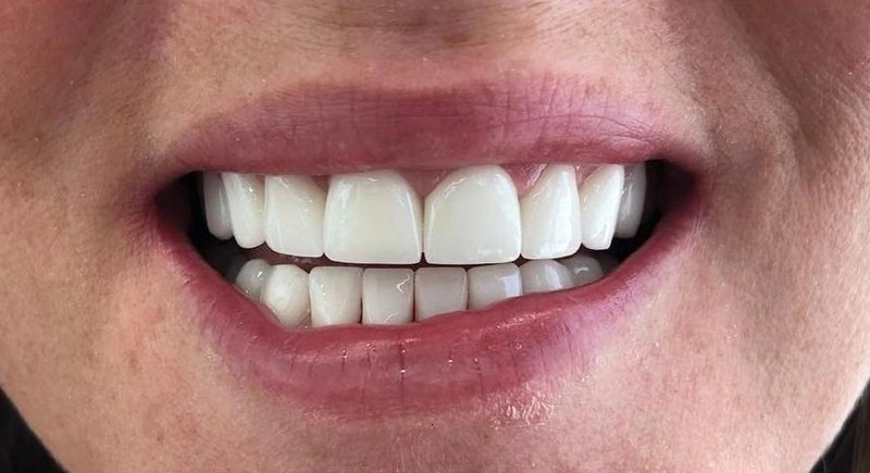 After Treatment 6