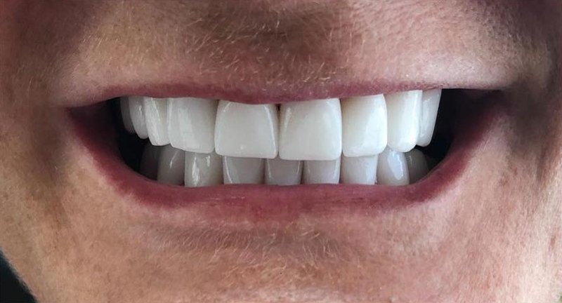 After Treatment 7