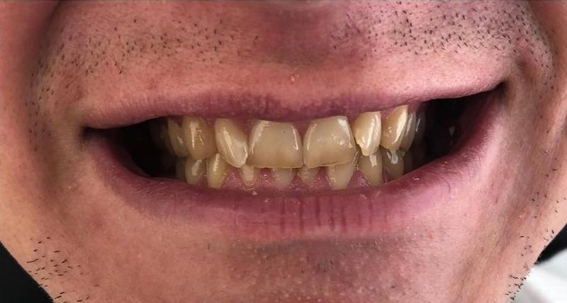 Before Treatment 4
