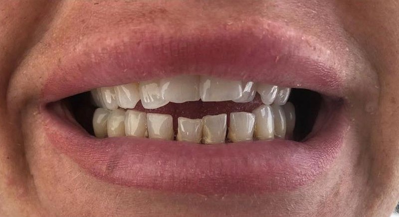 Before Treatment 5