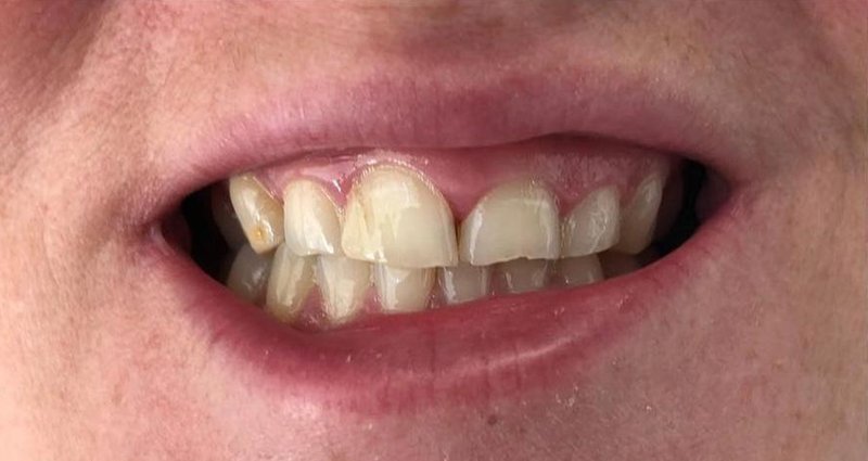 Before Treatment 6
