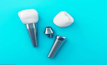 Dental Implants